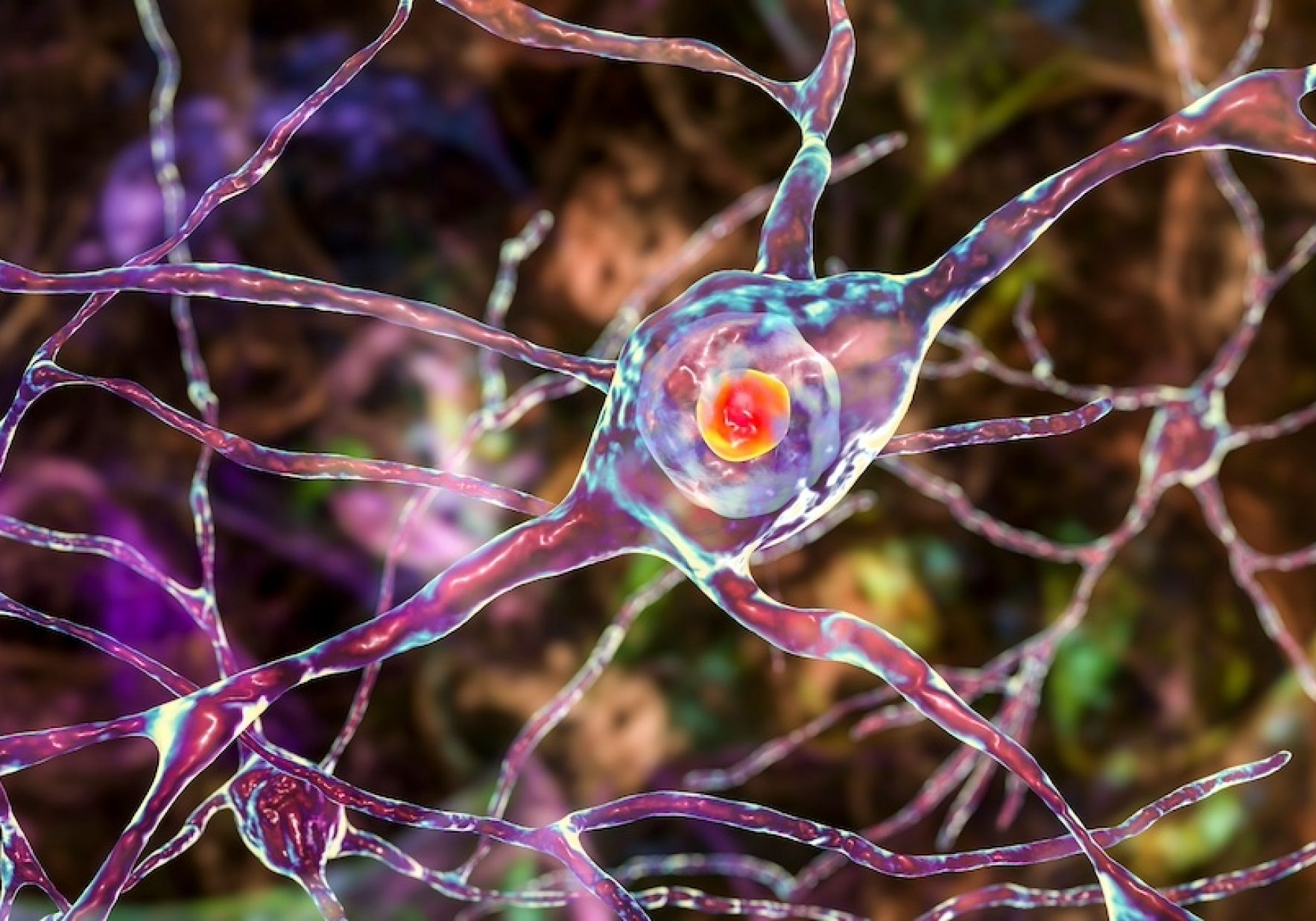 Huntingtons Neurons In Dorsal Striatum Shutterstock Kateryna Kon