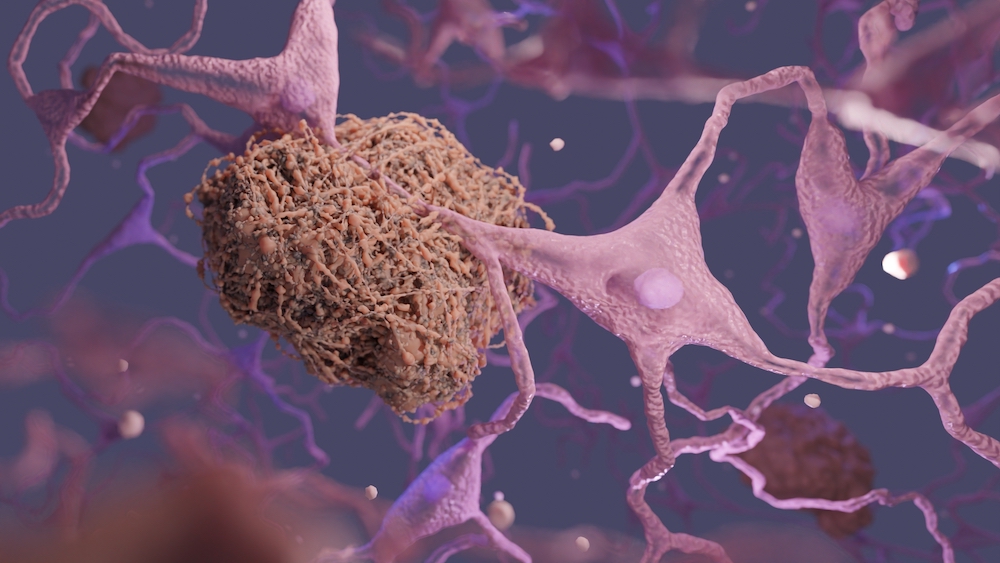 Amyloid plaques surrounding a neuron