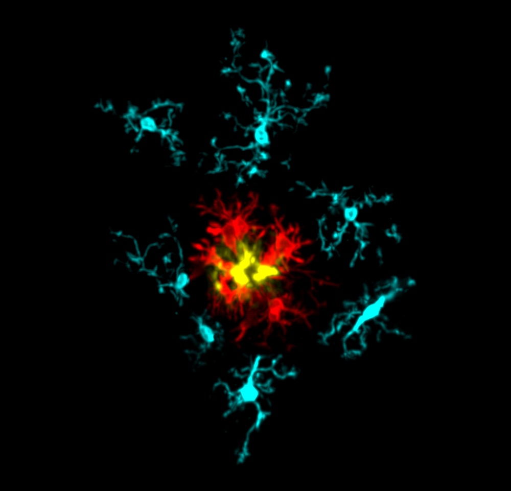 Microglia around an amyloid plaque