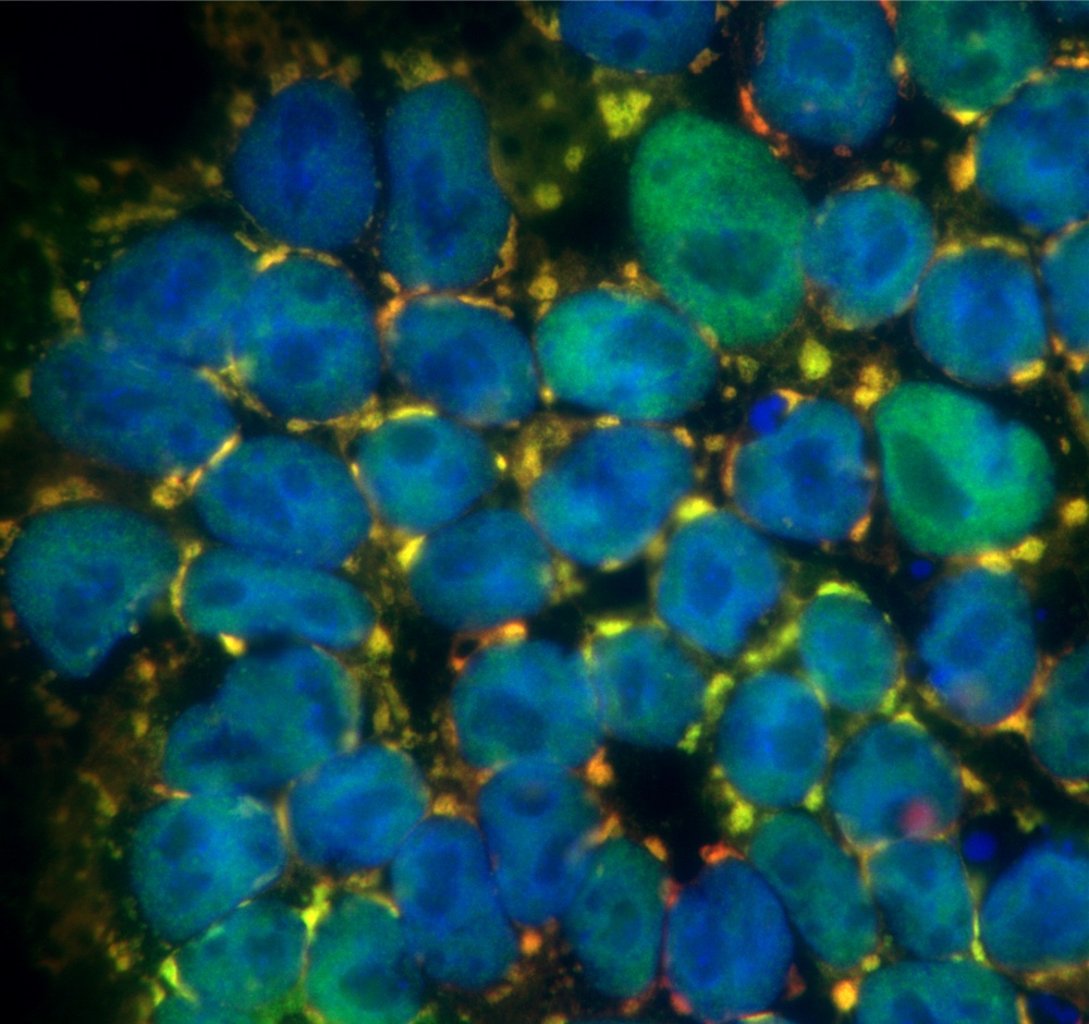 ALS-mutant FUS (in green) forms stress granules in the cytoplasm of induced pluripotent stem cells