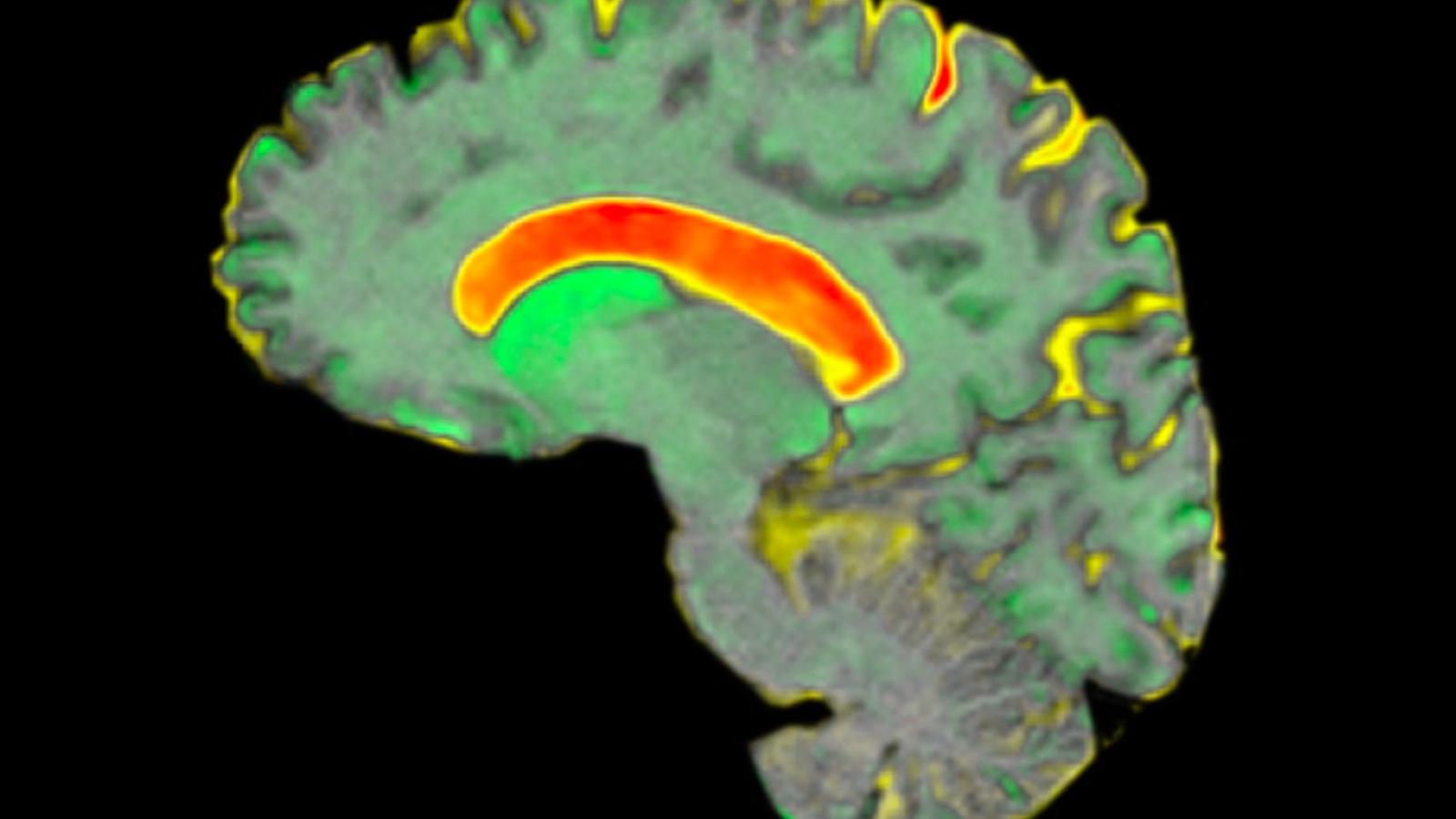 A scan of a huntington's brain