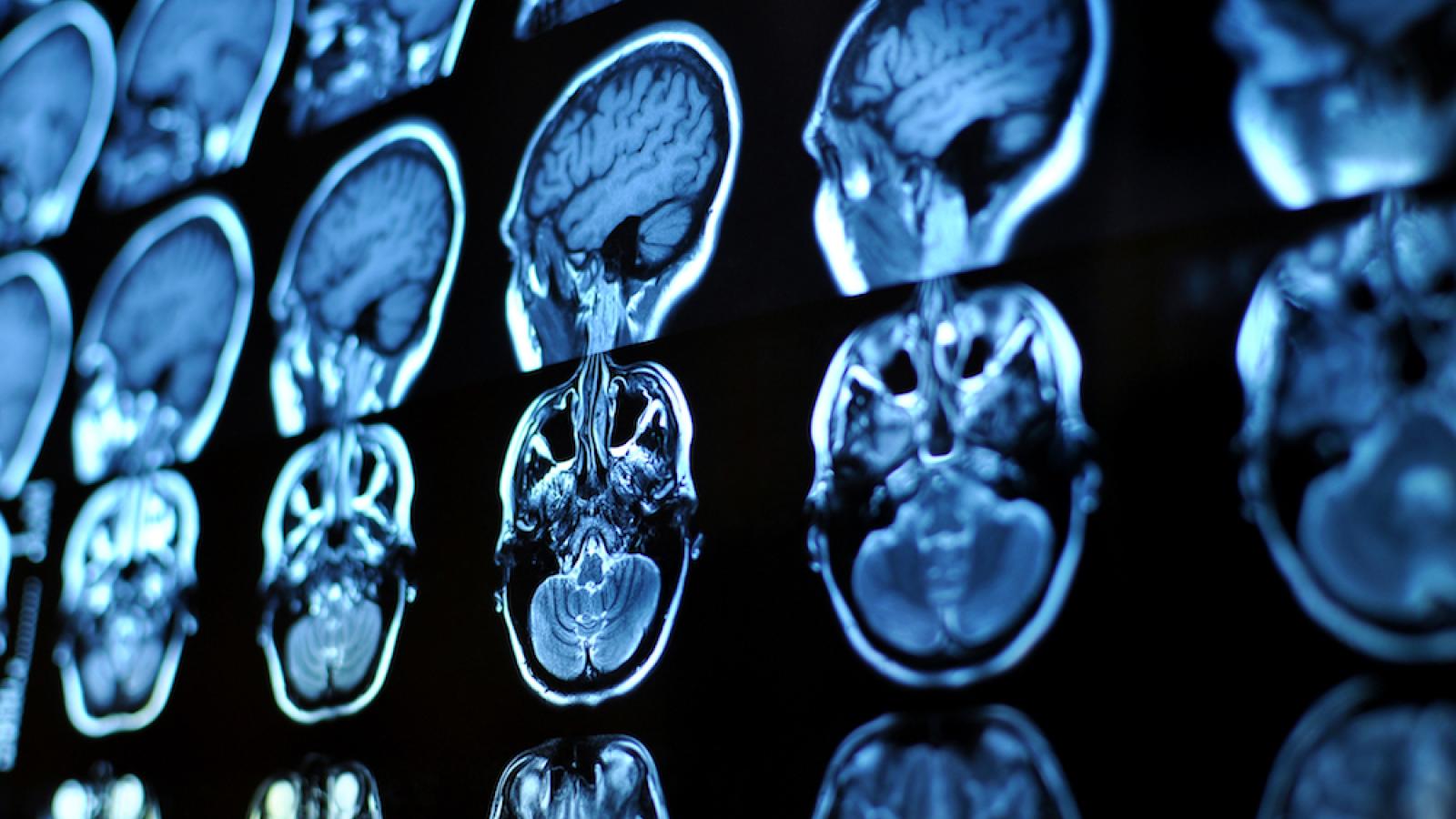 Photo of multiple brain scans
