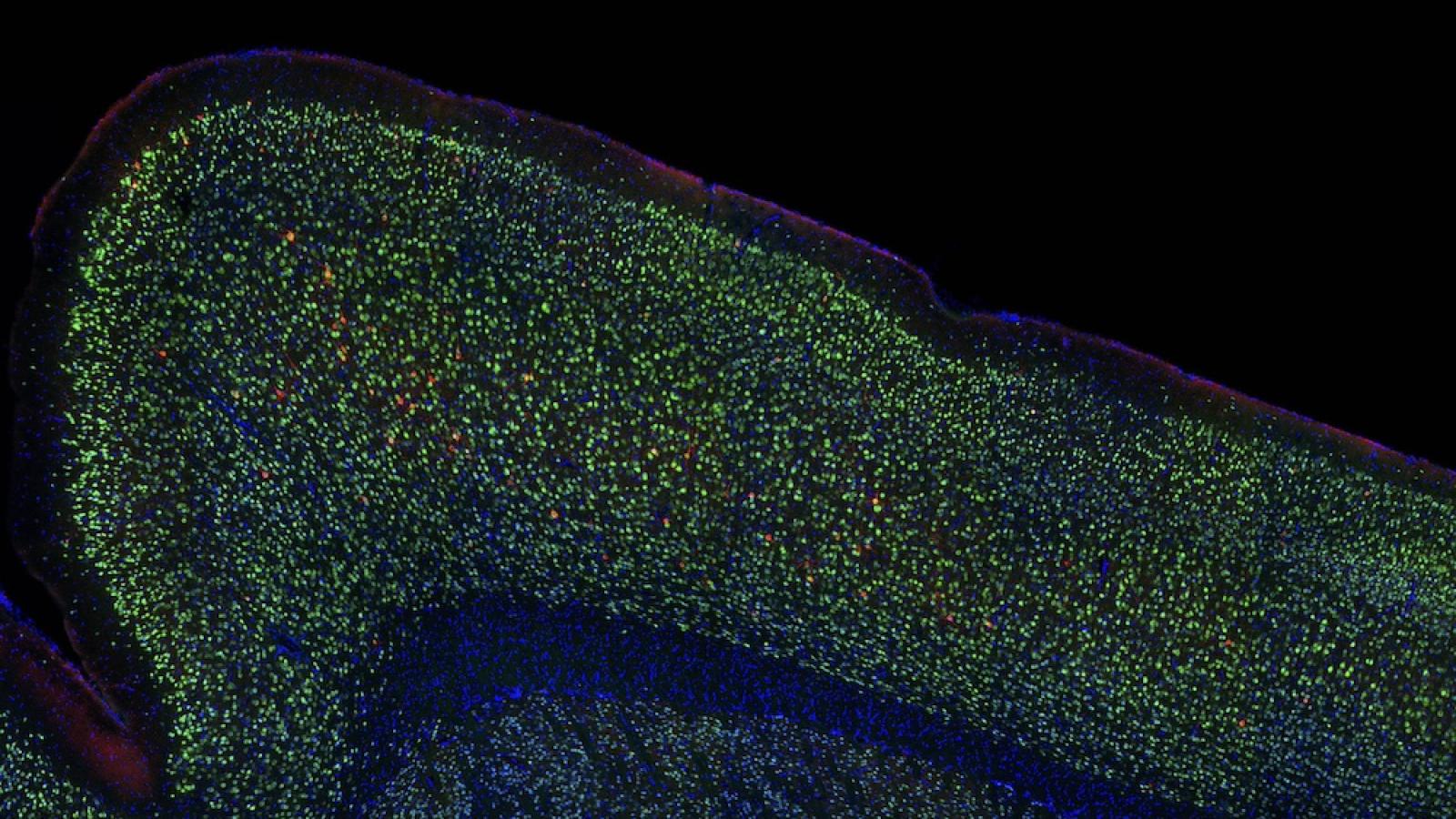 Neurons (green) with tau aggregates (red)