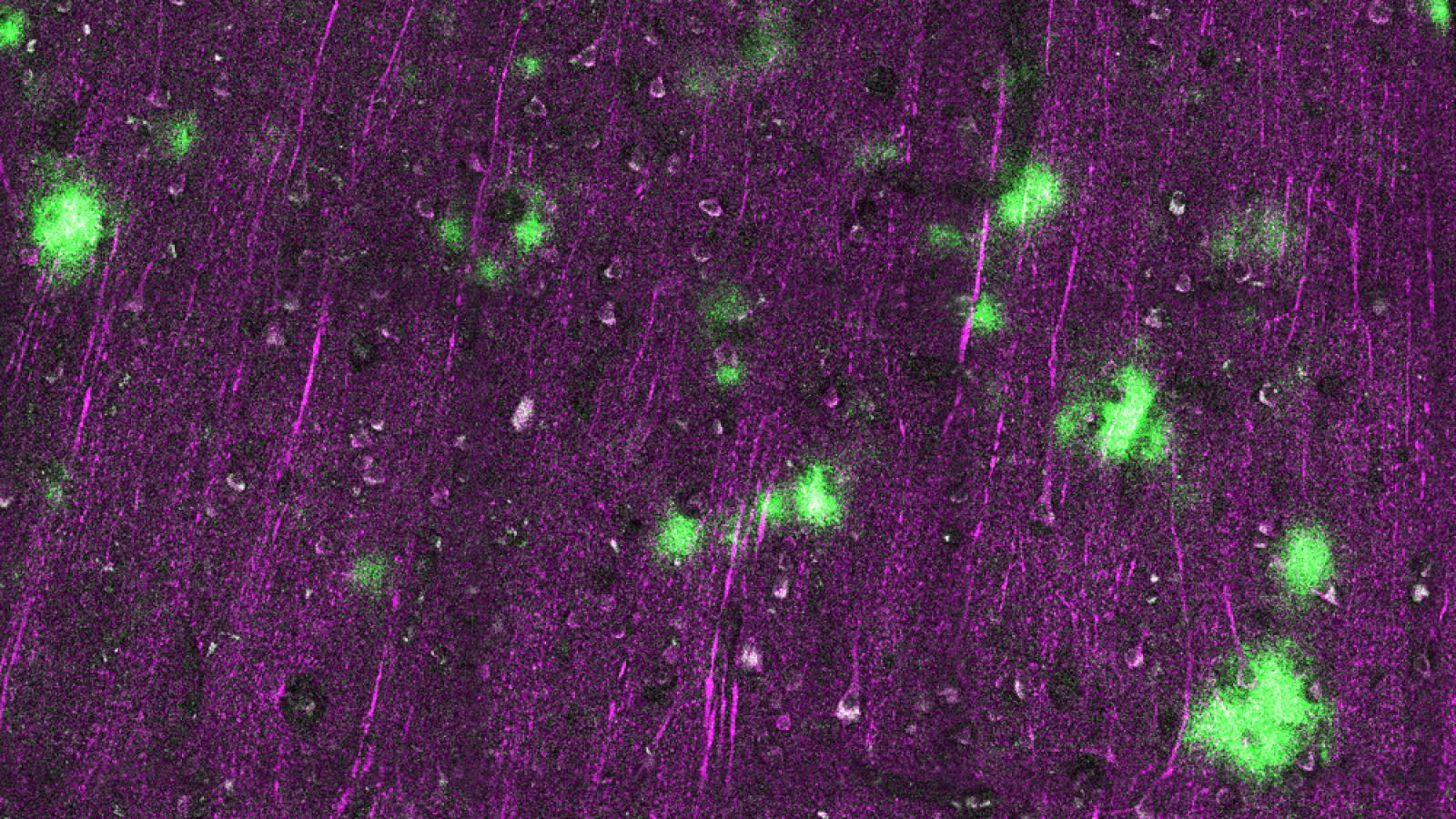 Piece of human brain cortex stained amyloid beta protein