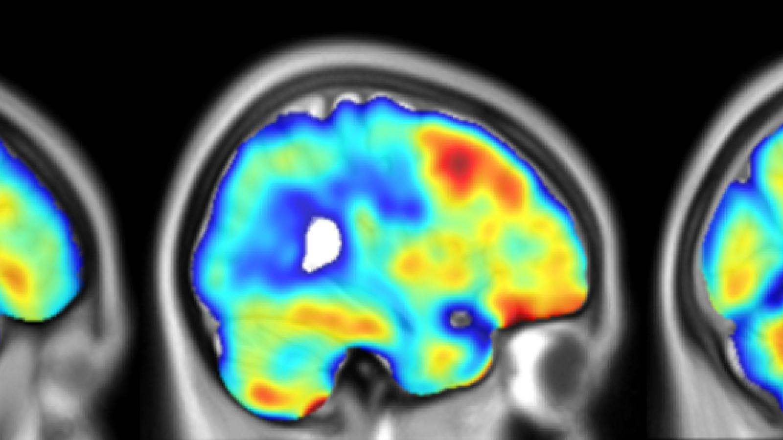 Three brains with dementia imaged with PET-TSPO