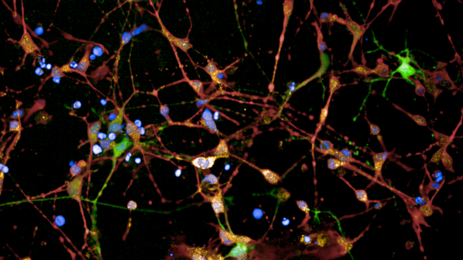 Huntington's patient brain cells