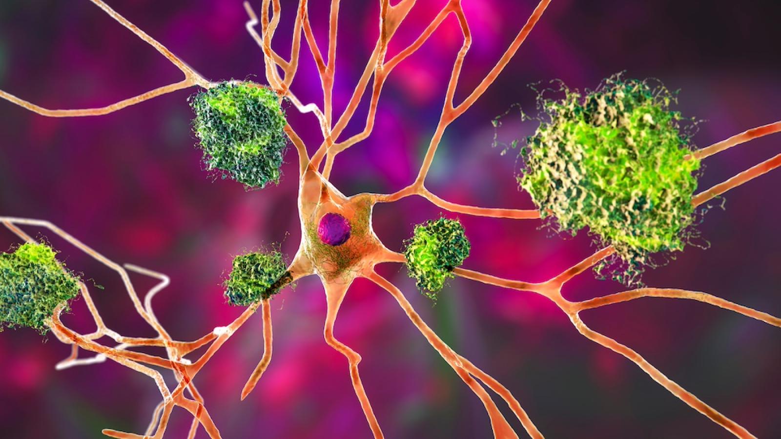 Neuron in Alzheimer's