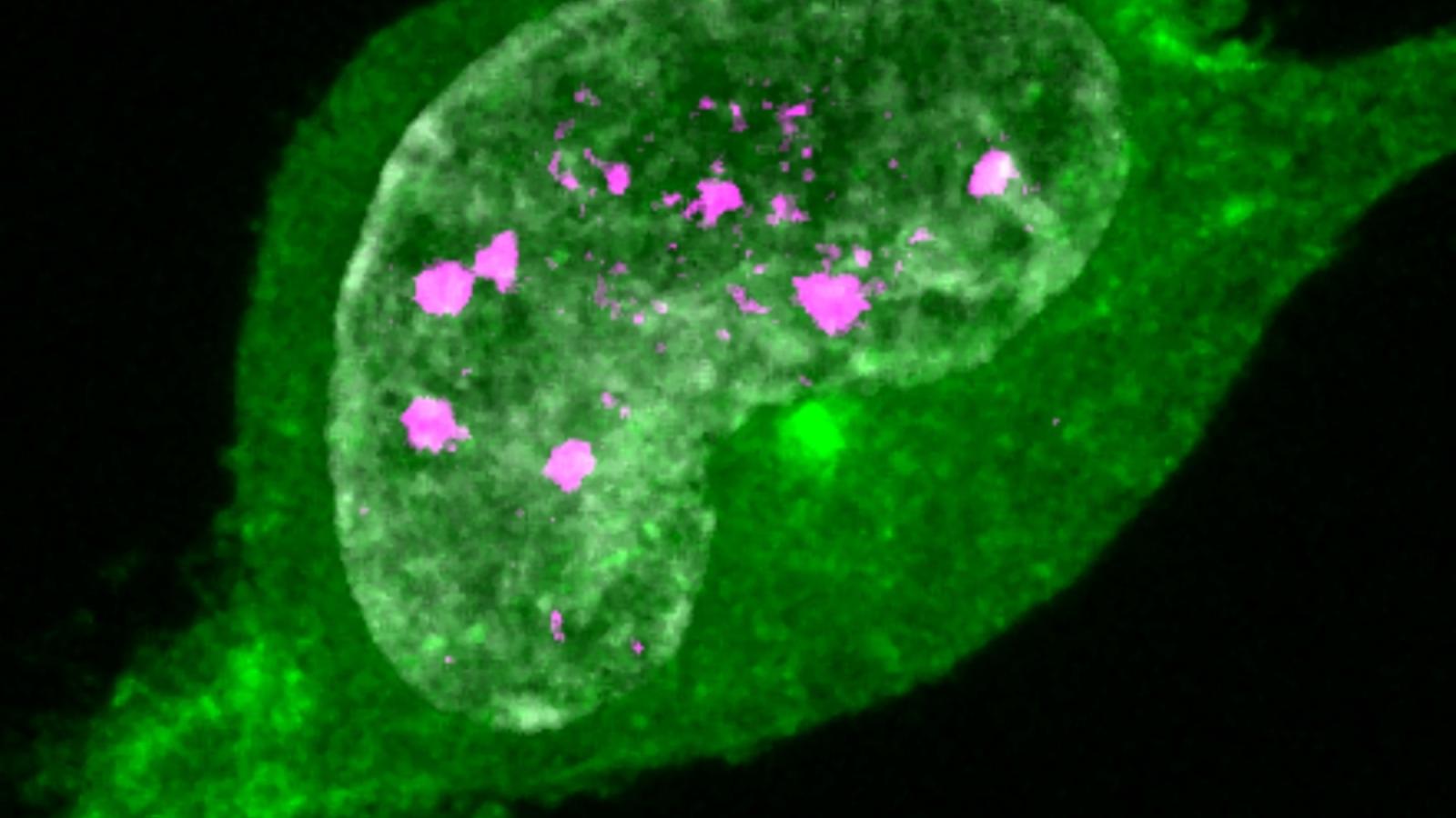 TREX1 with an RVCL mutation (Green) is mislocalised throughout the cell, including in the nucleus where it causes DNA damage (53BP1, magenta).