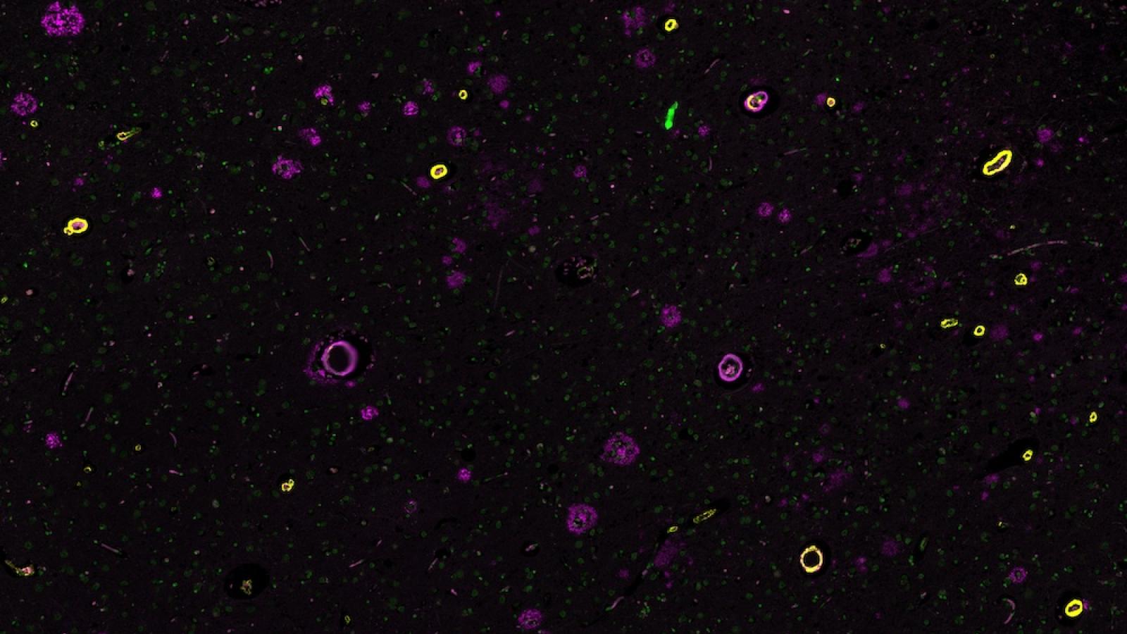 a section of brain tissue from a person with both cerebral amyloid angiopathy (CAA) and Alzheimer’s disease.