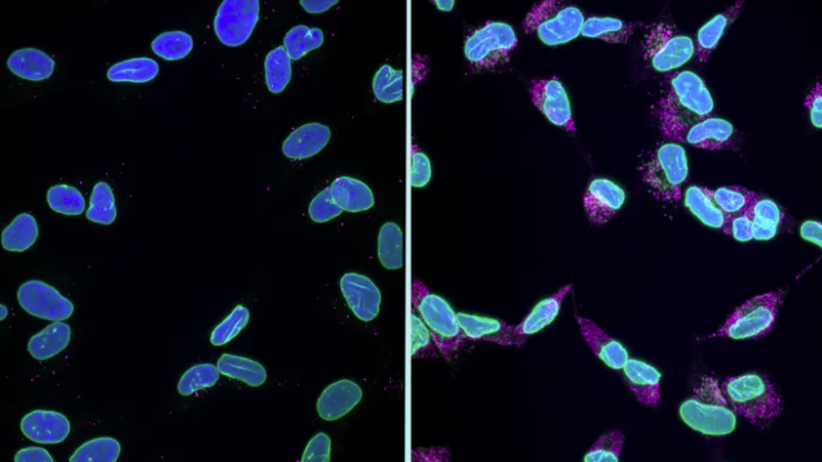 Cells showing signs of karyoptosis