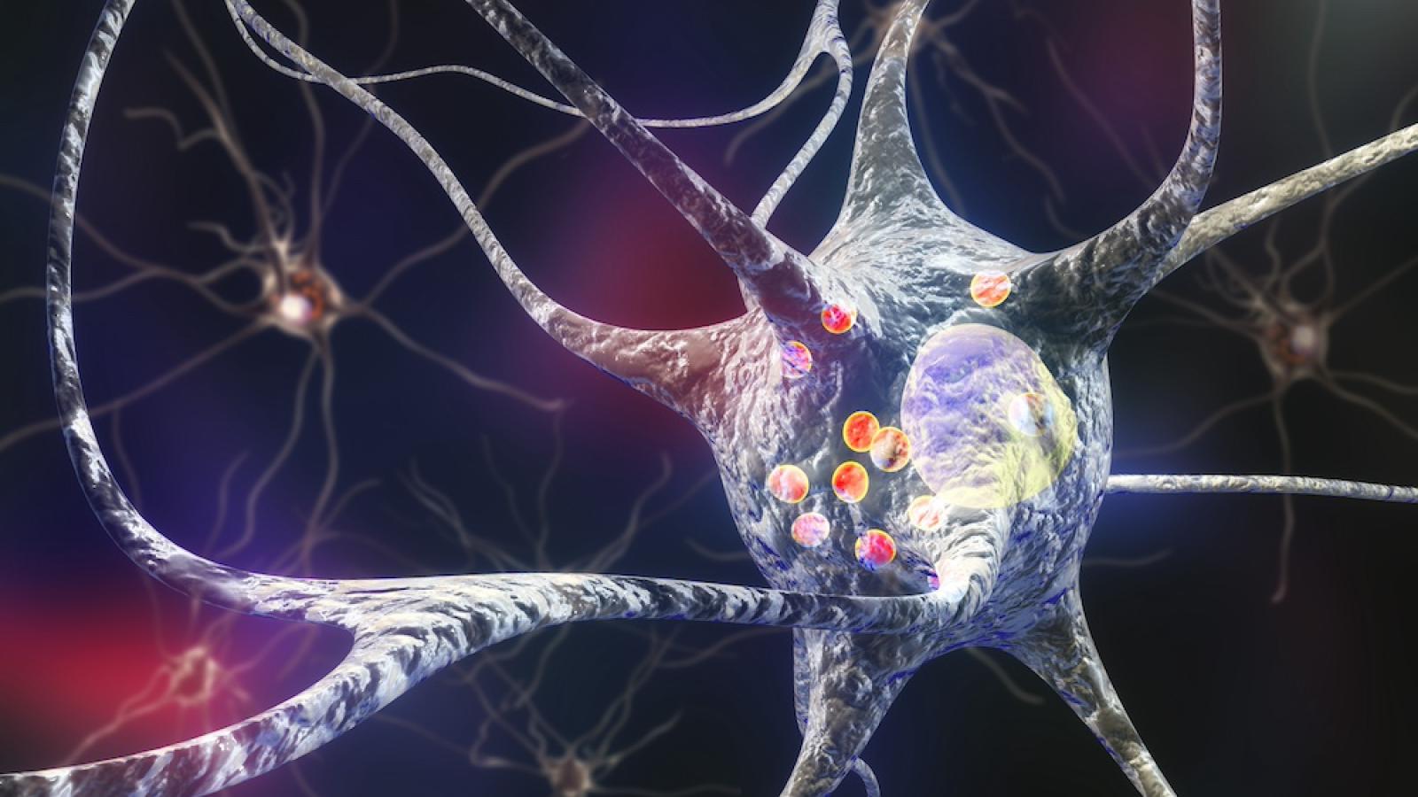 lewy-body-in-neuron