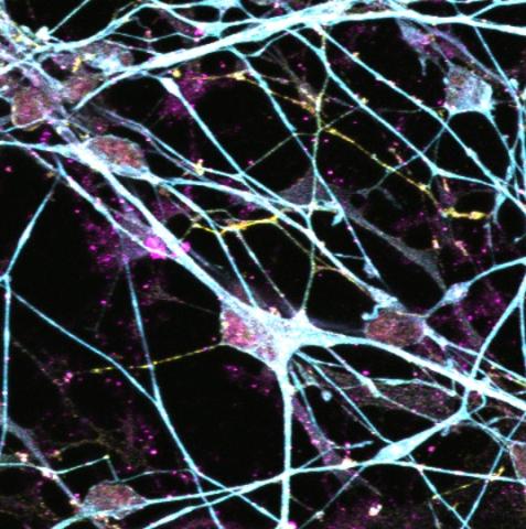 Human iPSC neurons from researcher Jamie Toombs