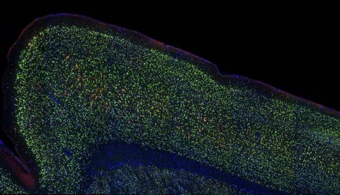 Neurons (green) with tau aggregates (red)