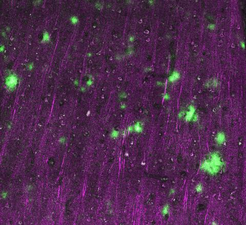 Piece of human brain cortex stained amyloid beta protein