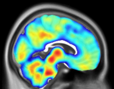 A brain with PSP dementia imaged with PET-TSPO