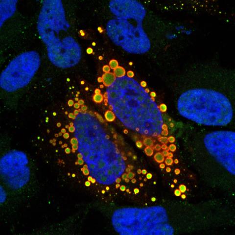 Cytoplasmic mutant TAF15 engulfs U12 snRNAs in the cytoplasm of HeLa cells