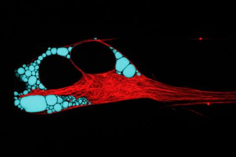 Human neuron with pathologically perturbed ER