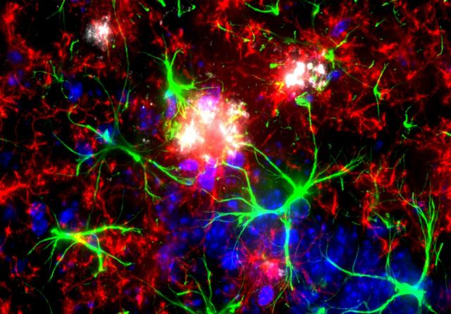 Microglia and astrocytes around amyloid plaque
