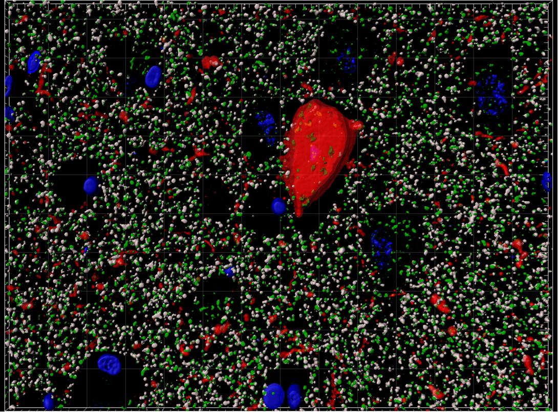 Human neurofibrillary tangle, nuclei, presynapses, postsynapses imaged with array tomography Credit: Caitlin Davies