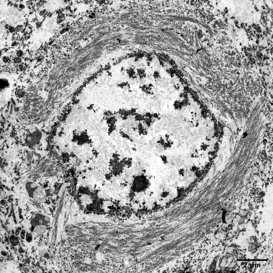 A neurofibrillary tangle