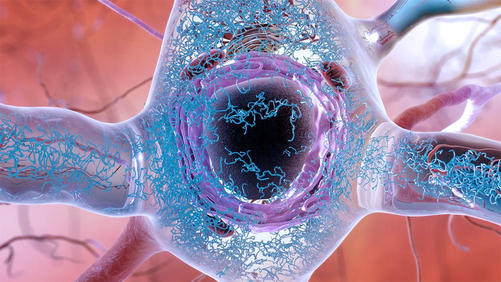 Tau protein clumped in a neuron