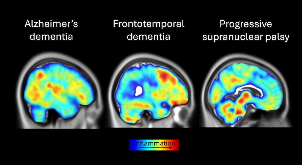 Images of TSPO PET as marker of microglial activation in volunteers with Alzheimer’s dementia, frontotemporal dementia and progressive supranuclear palsy.