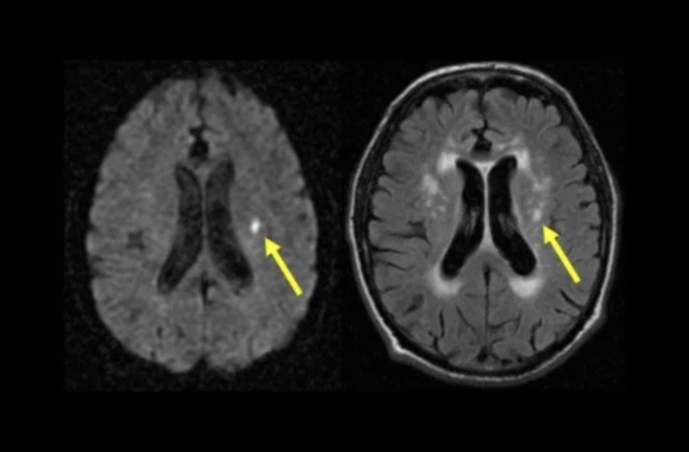 MRI scan showing lacunar stroke