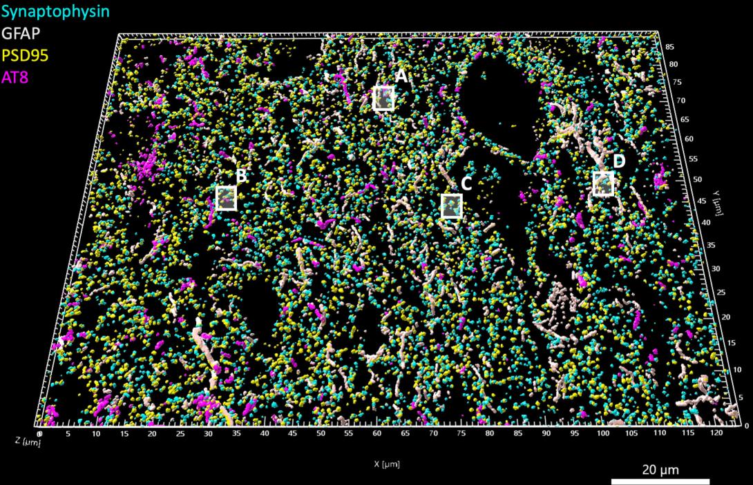 3D reconstruction of high-resolution array tomography images of the frontal cortex from a person who died with Progressive Supranuclear Palsy