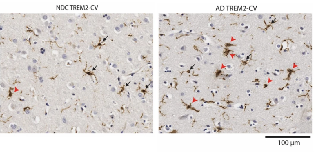 more 'active' immune cells (marked with red arrowheads) and fewer 'resting' ones (marked with black arrows) in the brains of Alzheimer's patients, compared to healthy brains.