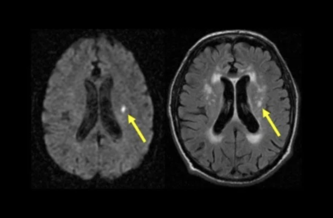 Mri Scans Lacunar Stroke