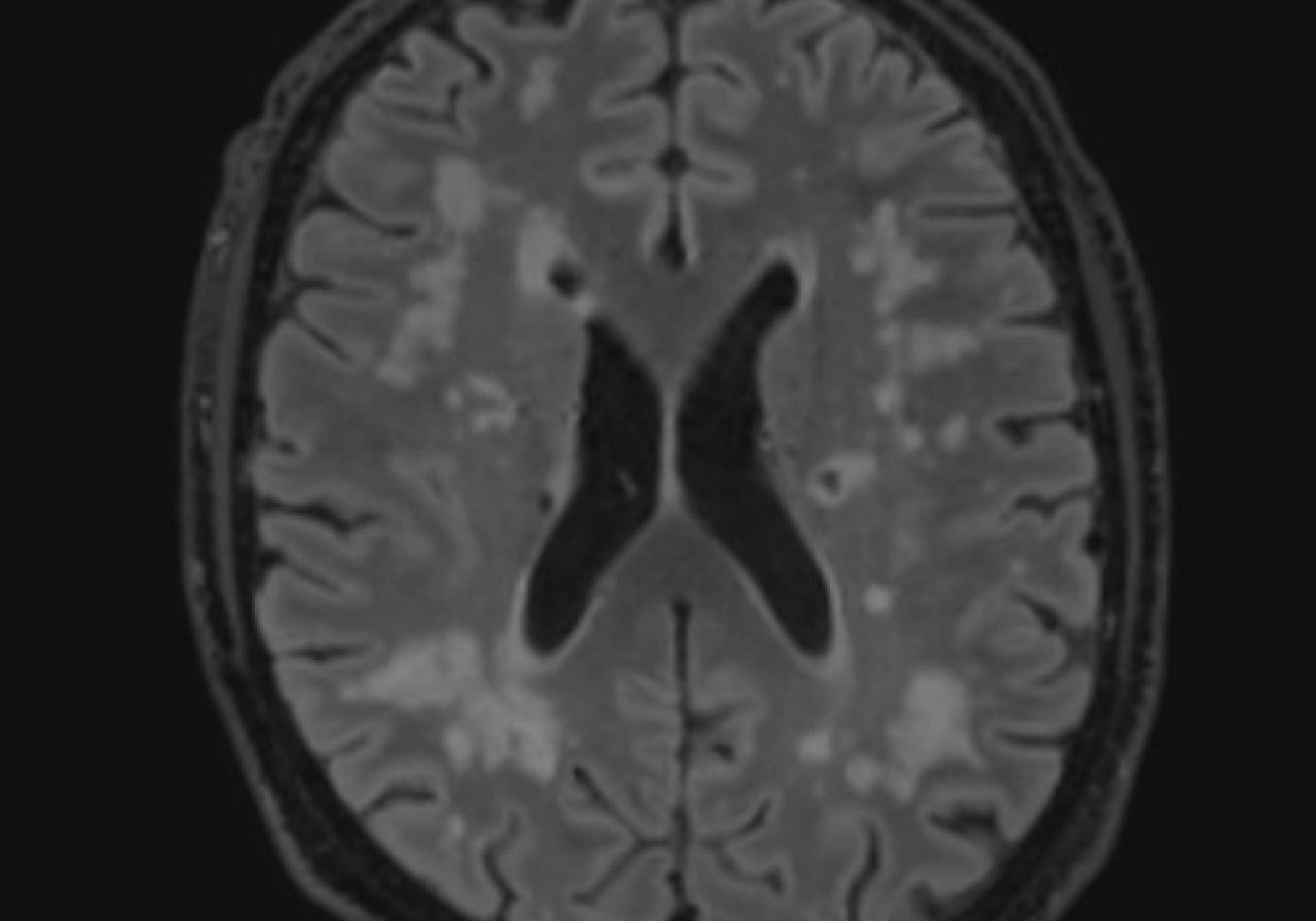 Cerebral Small Vessel Disease Wardlaw