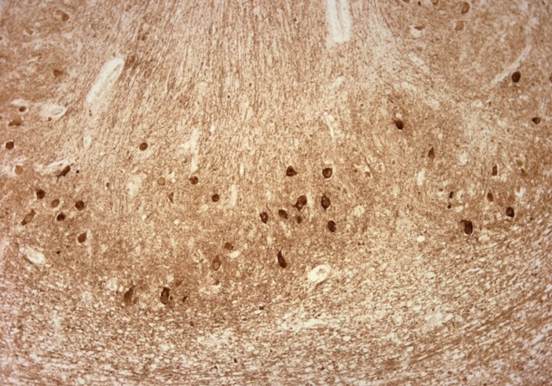 Lewy  Body  Dementia  Pathology  Bartels