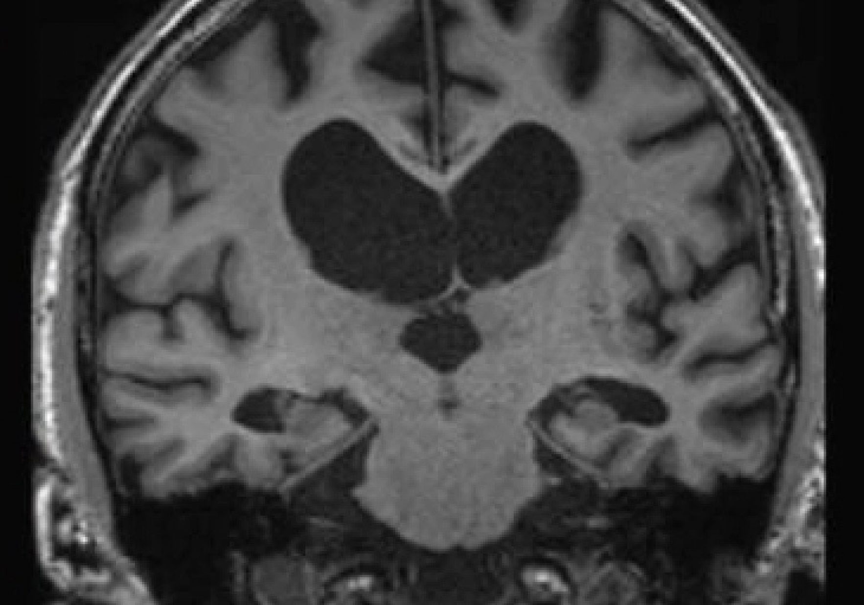 Mri Atrophy Example