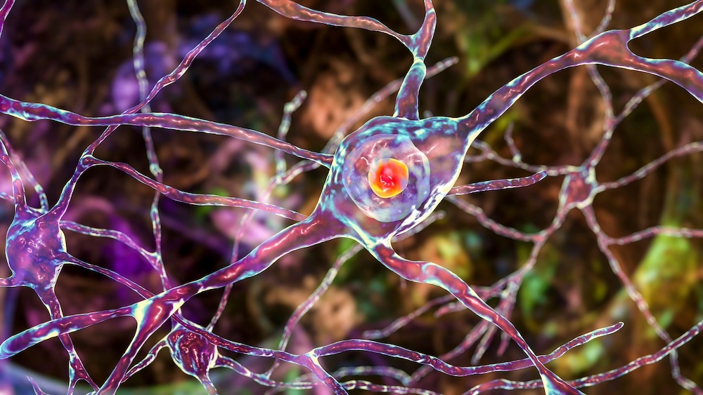 Huntingtons Neurons In Dorsal Striatum Shutterstock Kateryna Kon