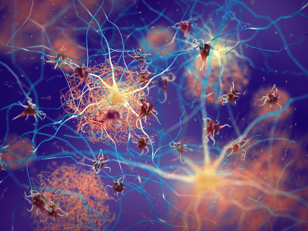Neurons And Plaques Nobeastsofierce Shutterstock Red